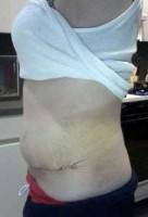 Recovery after tummy tuck surgery photos