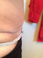 Scar of tummy tuck with lipo