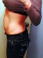 Should i lose weight before tummy tuck image