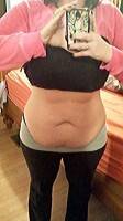 Should i lose weight before tummy tuck photo