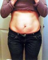 Should i lose weight before tummy tuck surgery
