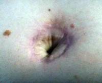 The Belly button after tummy tuck scar revision