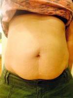 The Good candidate for tummy tuck