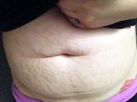The Liposuction or tummy tuck