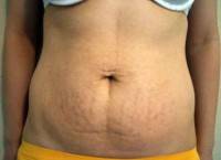 The difference between mini tummy tuck and full