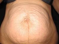 The liposuction with tummy tuck