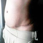 The recovery time for a tummy tuck