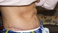 The tummy tuck after liposuction