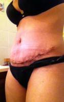 The tummy tuck after pictures
