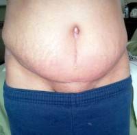 The tummy tuck scar removal