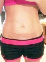 The tummy tuck without scars