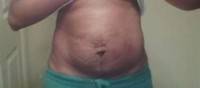 Tummy Tuck Muscles before abdominoplasty