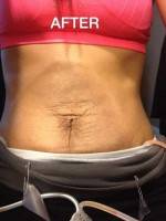 Tummy Tuck Muscles photo after abdominoplasty