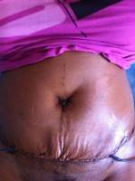 Tummy tuck african americans photo of patient