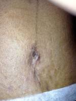 Tummy tuck after a c-section image