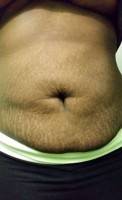 Tummy tuck after liposuction image
