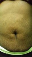Tummy tuck after liposuction photo