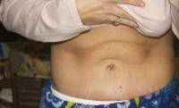 Tummy tuck after liposuction photos
