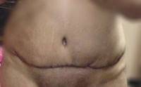 Tummy tuck after patients pictures