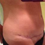 Tummy tuck after picture images
