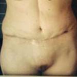 Tummy tuck after pictures after c section photo