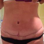 Tummy tuck after pictures lower