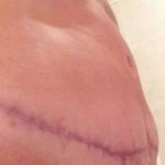 Tummy tuck after pictures scar image