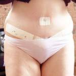Tummy tuck after pictures swelling