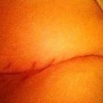 Tummy tuck after surgery pictures