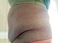 Tummy tuck and brazilian butt lift surgery