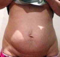 Tummy tuck and muscle repair before