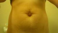 Tummy tuck before after pictures photo