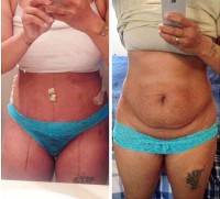 Tummy tuck breast augmentation before and after