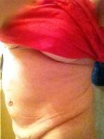 Tummy tuck hernia repair photo