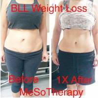 Tummy tuck mesotherapy before and after