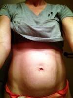 Tummy tuck operation muscle repair