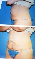 Tummy tuck result before