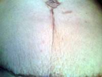 Tummy tuck scar after a c-section
