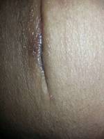 Tummy tuck scar before and after image
