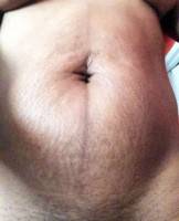 Tummy tuck surgery after a c-section