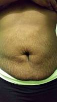 Tummy tuck surgery after liposuction