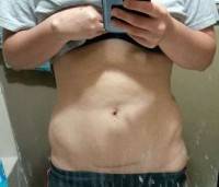 Tummy tuck surgery post c section