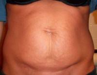 Tummy tuck surgery scar removal