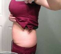 Tummy tuck with lipo before