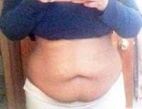 Tummy tuck with liposuction photo