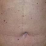 Tummy tuck with muscle repair image