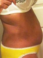 Tummy tuck with muscle tightening photo