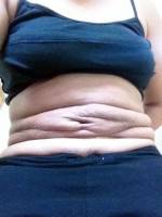 Tummy tuck with vertical scar need