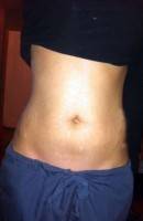 Tummy tuck with vertical scar photo