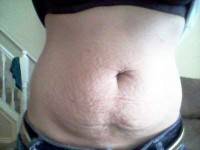 Tummy tuck without vertical scars photo